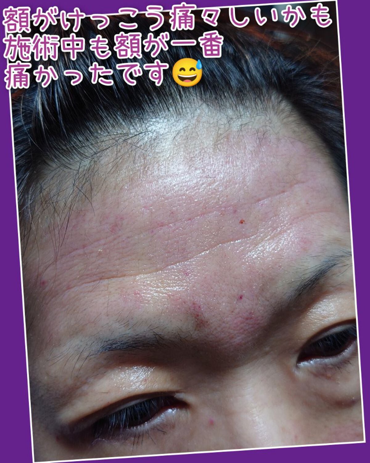 瞳子うさぎ@定期的に投稿ある方フォロバ on LIPS 「今まで埋没二重術や、糸リフトなど美容医療を経験してきましたが、..」(3枚目)