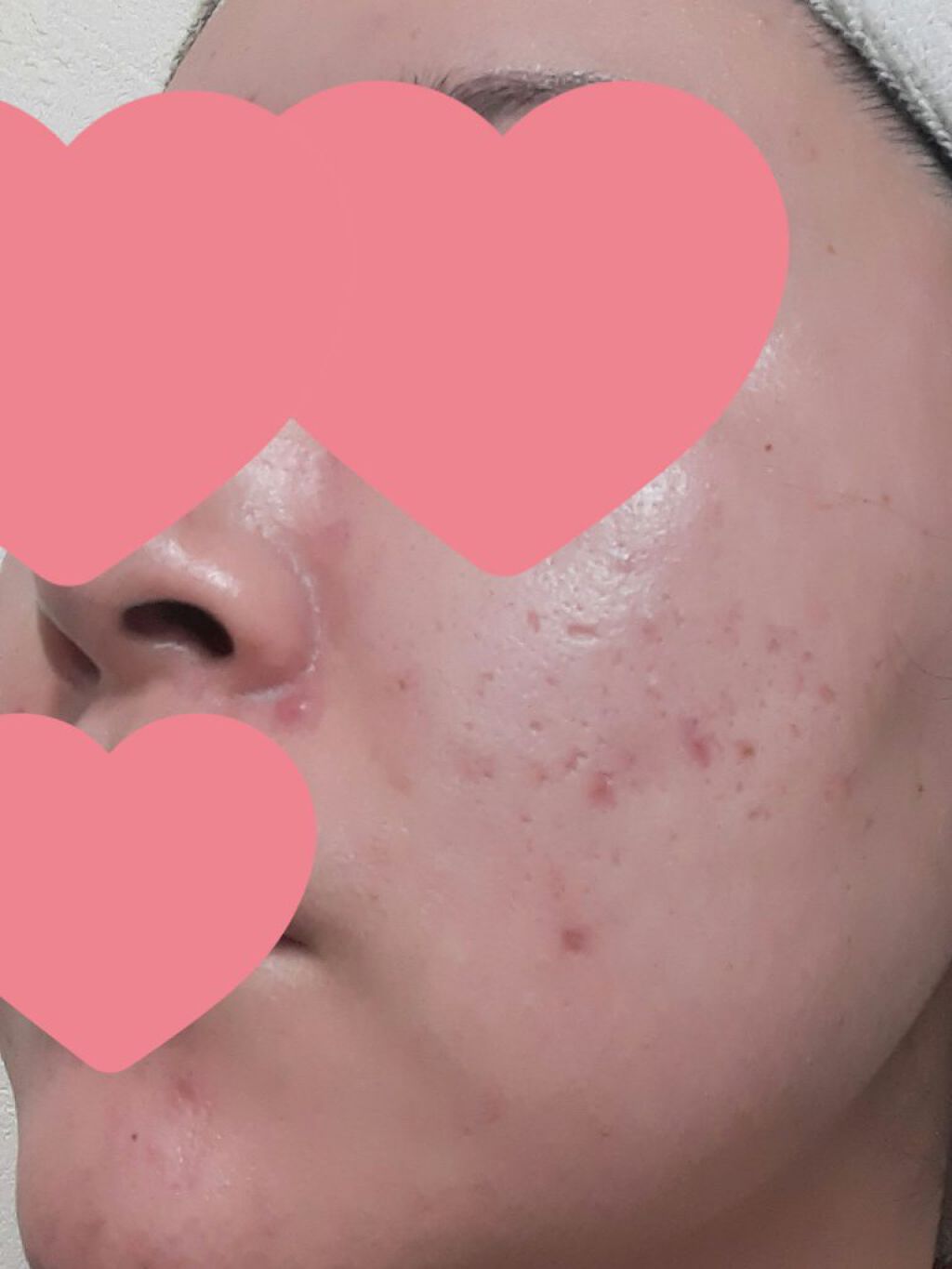 にきび治療薬C(医薬品)/ピンプリット/その他を使ったクチコミ(2枚目)