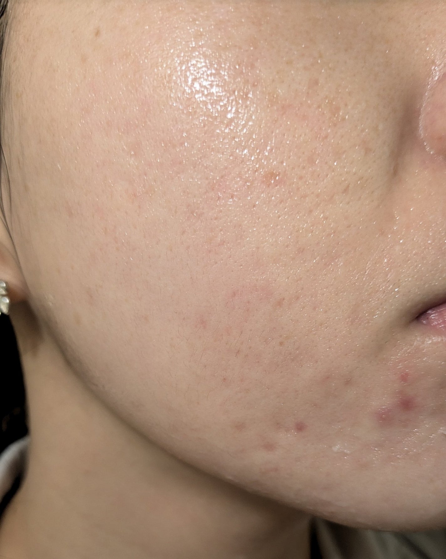 miina@汚肌工事録⚠️ on LIPS 「10/23の#汚肌工事録ついに口周りに大きなのができてしまいま..」(1枚目)