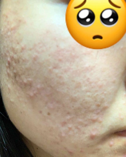 マシュマロホイップ 薬用アクネケア/ビオレ/泡洗顔を使ったクチコミ(3枚目)