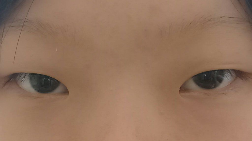 二重整形/その他を使ったクチコミ（2枚目）