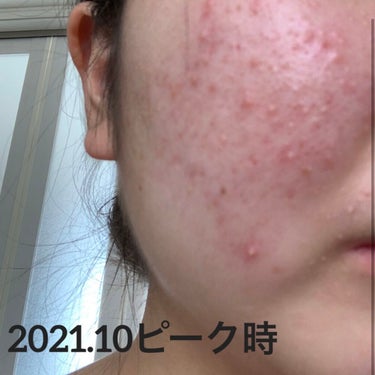 ちひろ on LIPS 「ニキビ日記最近悩んでるニキビがやっと落ち着いてきたので報告です..」（1枚目）