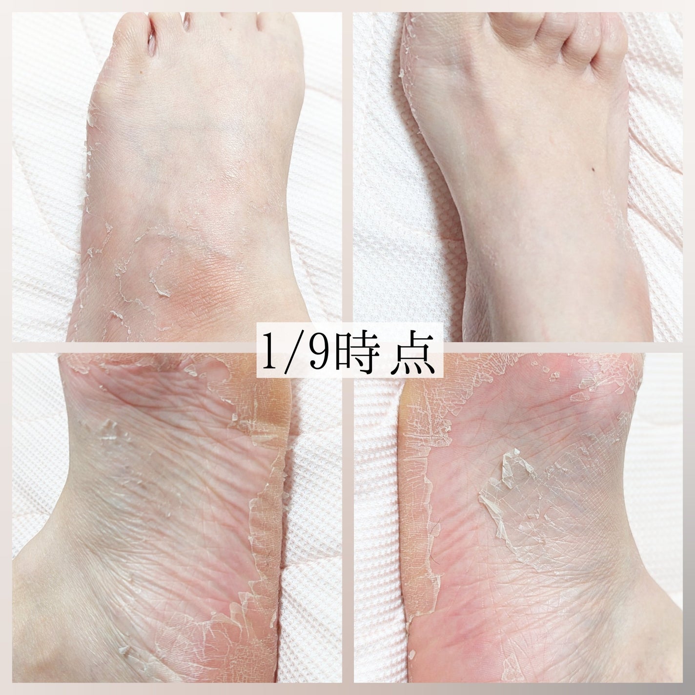 あしやすめ 足裏角質ケアパック/鎌倉ライフ/レッグ・フットケアを使ったクチコミ(6枚目)