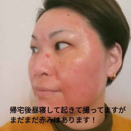 ビヨンセ奥二重向上委員長🥸LIPSパートナー🥳 on LIPS 「ダーマペン4をやってきたよ!!何種類か選べる薬剤から私はボトッ..」(7枚目)