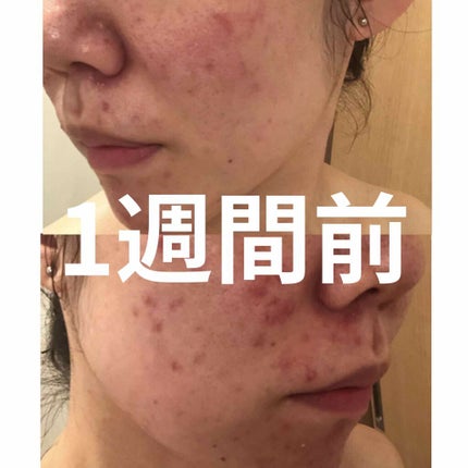 薬用 しみ 集中対策 美容液/メラノCC/美容液を使ったクチコミ(2枚目)