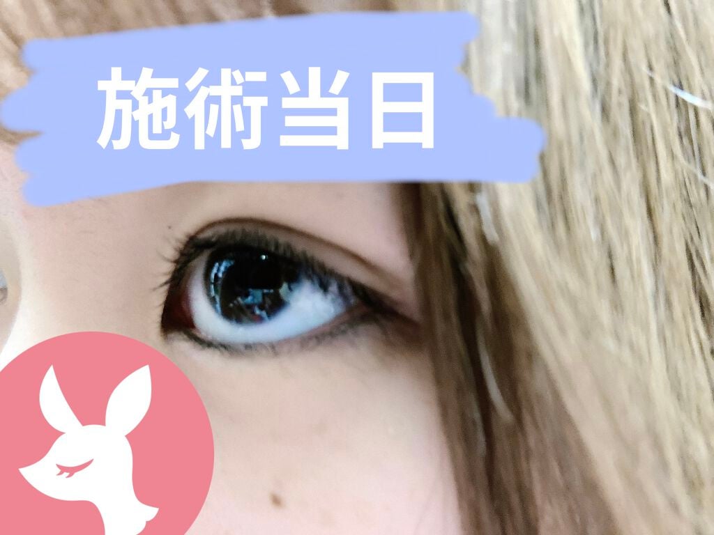 ふちこ on LIPS 「埋没してから10日経ちました。すっぴんでもずっと二重だしまつ毛..」(2枚目)