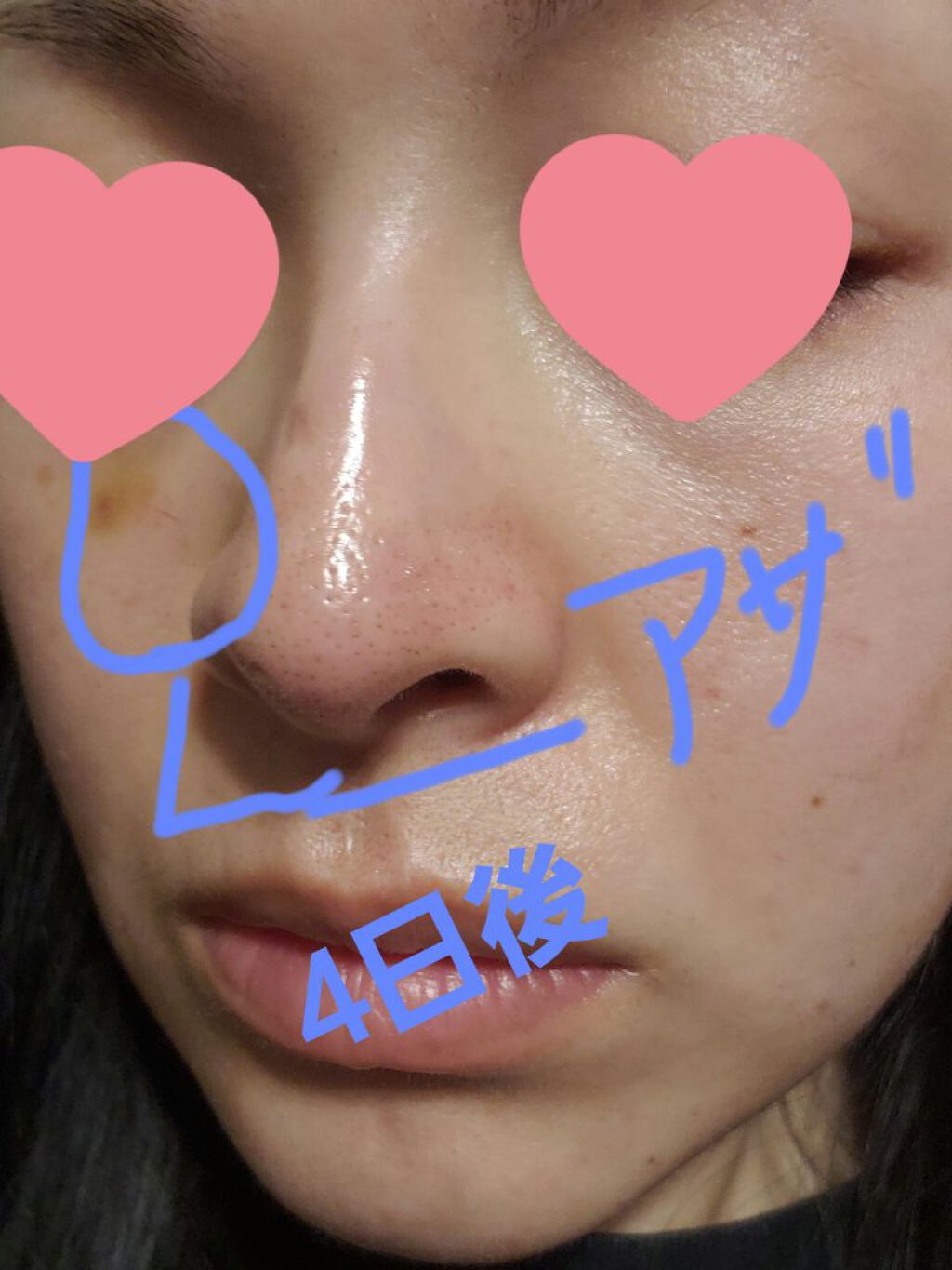 ダーマペン・ダーマスタンプ/MyM/その他スキンケアグッズを使ったクチコミ(2枚目)