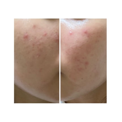 ぽむ on LIPS 「2023.9.13皮膚科に受診 エピデュオとヘパリン処方1枚目..」(5枚目)