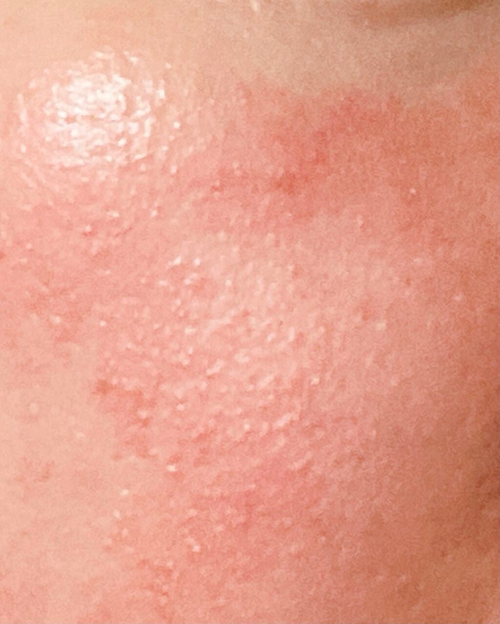 スキンケアプログラム AD/ACSEINE/トライアルキットを使ったクチコミ(2枚目)