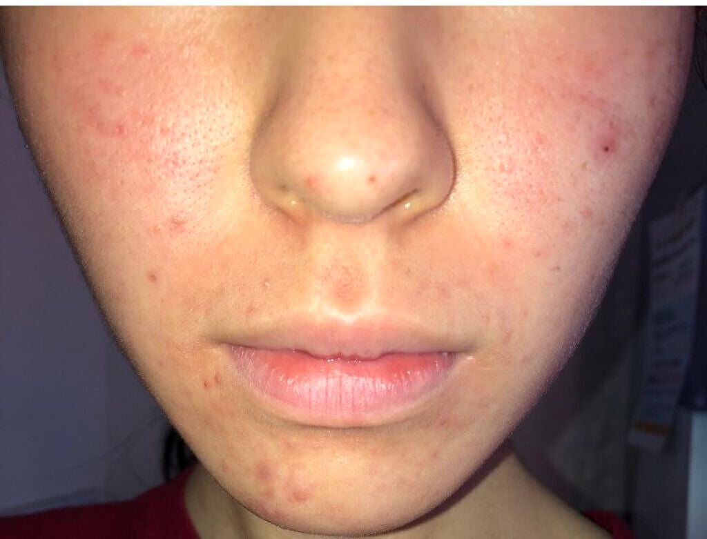 ノブ A アクネソープ/NOV/洗顔石鹸を使ったクチコミ(1枚目)