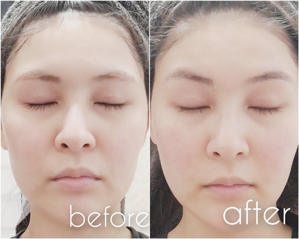 FacePump Premium(フェイスポンプ プレミアム)/the beautools/美顔器・マッサージを使ったクチコミ(3枚目)