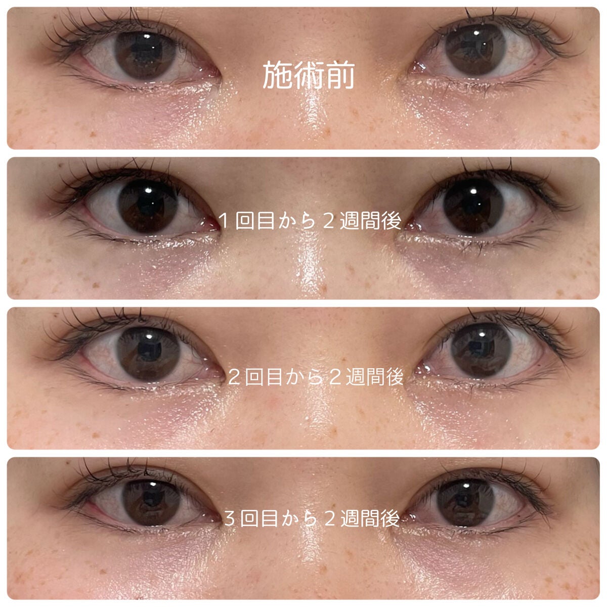 もい on LIPS 「今回、モティーフ銀座クリニックでスネコス注射3回の施術を受けま..」(6枚目)