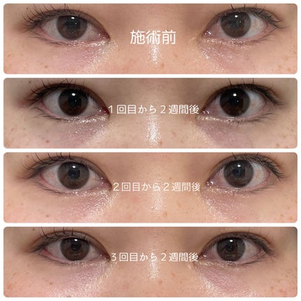 もい on LIPS 「今回、モティーフ銀座クリニックでスネコス注射3回の施術を受けま..」(6枚目)