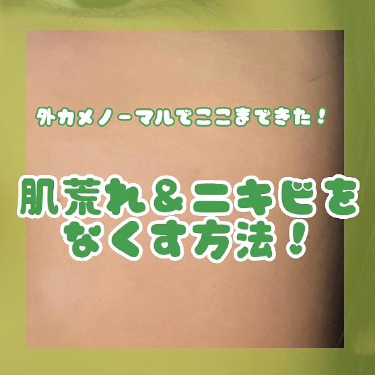 オロナインＨ軟膏 (医薬品)/オロナイン/その他を使ったクチコミ（1枚目）