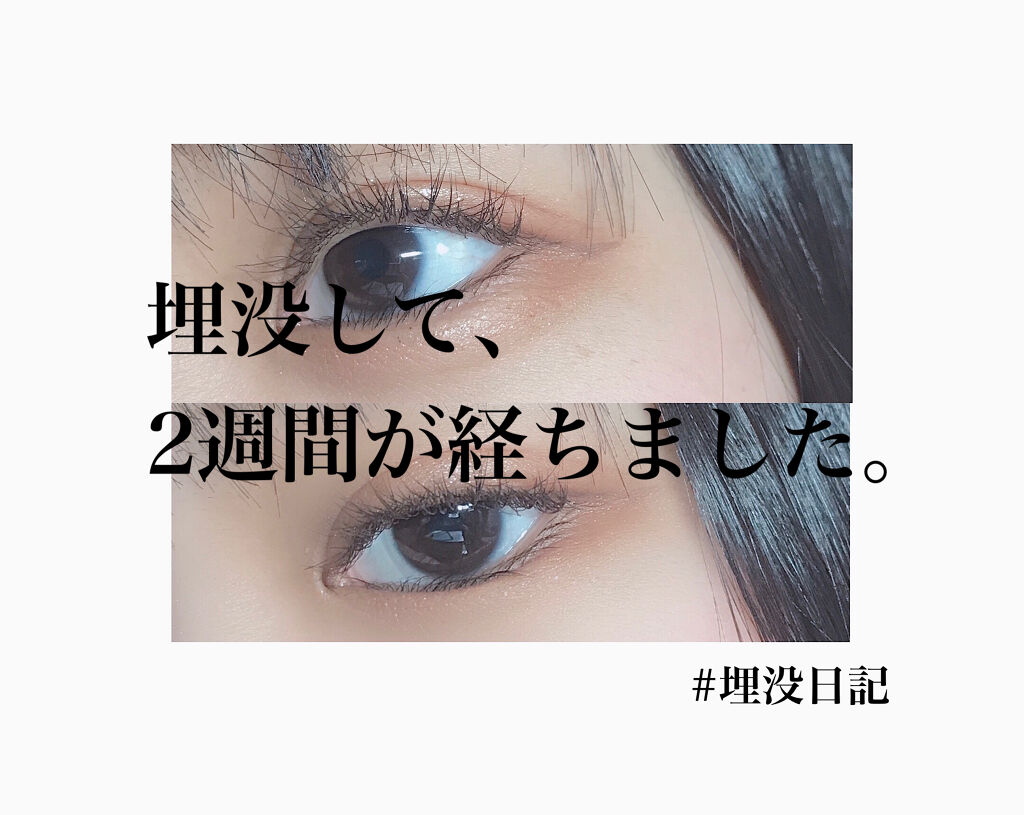 二重整形/その他を使ったクチコミ（1枚目）