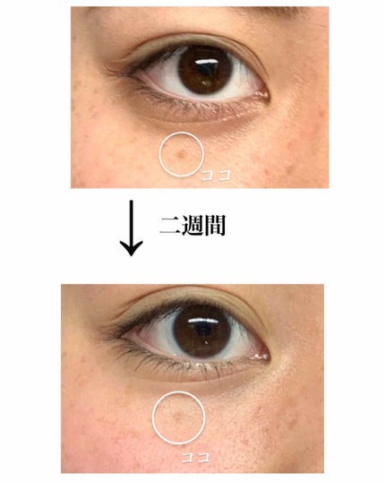 薬用 しみ 集中対策 美容液/メラノCC/美容液を使ったクチコミ(2枚目)