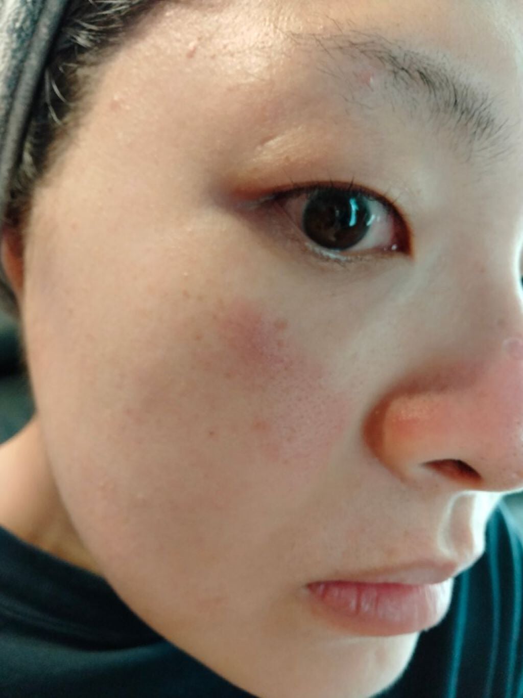 ダーマペン・ダーマスタンプ/MyM/その他スキンケアグッズを使ったクチコミ(4枚目)