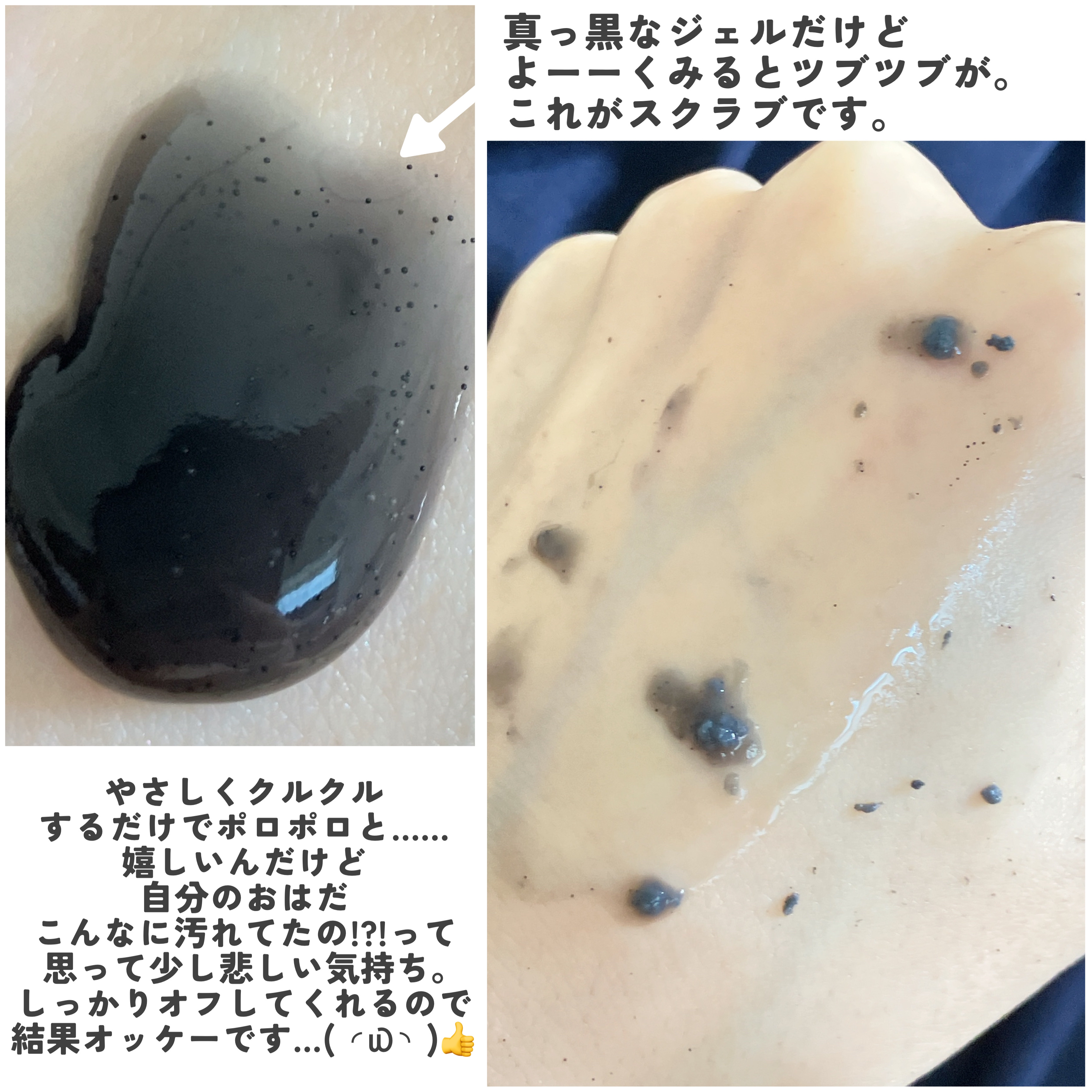 DETクリア ブライト＆ピール ピーリングジェリー＜炭タイプ＞/Detclear/ピーリングを使ったクチコミ（3枚目）