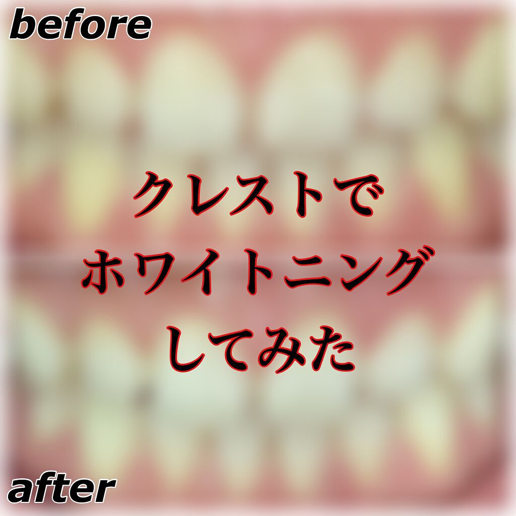 クレスト3dホワイトニング ホワイトストリップ プロフェッショナル エフェクツ クレストの使い方を徹底解説 歯の写真あり クレス By さあ 代前半 Lips