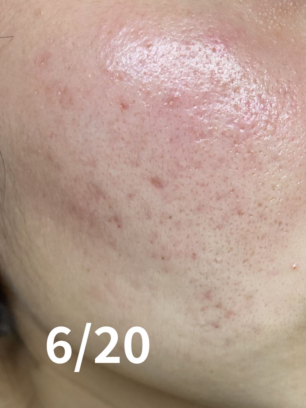 コレクチム軟膏0.5% (医薬品)/鳥居薬品/その他を使ったクチコミ（2枚目）