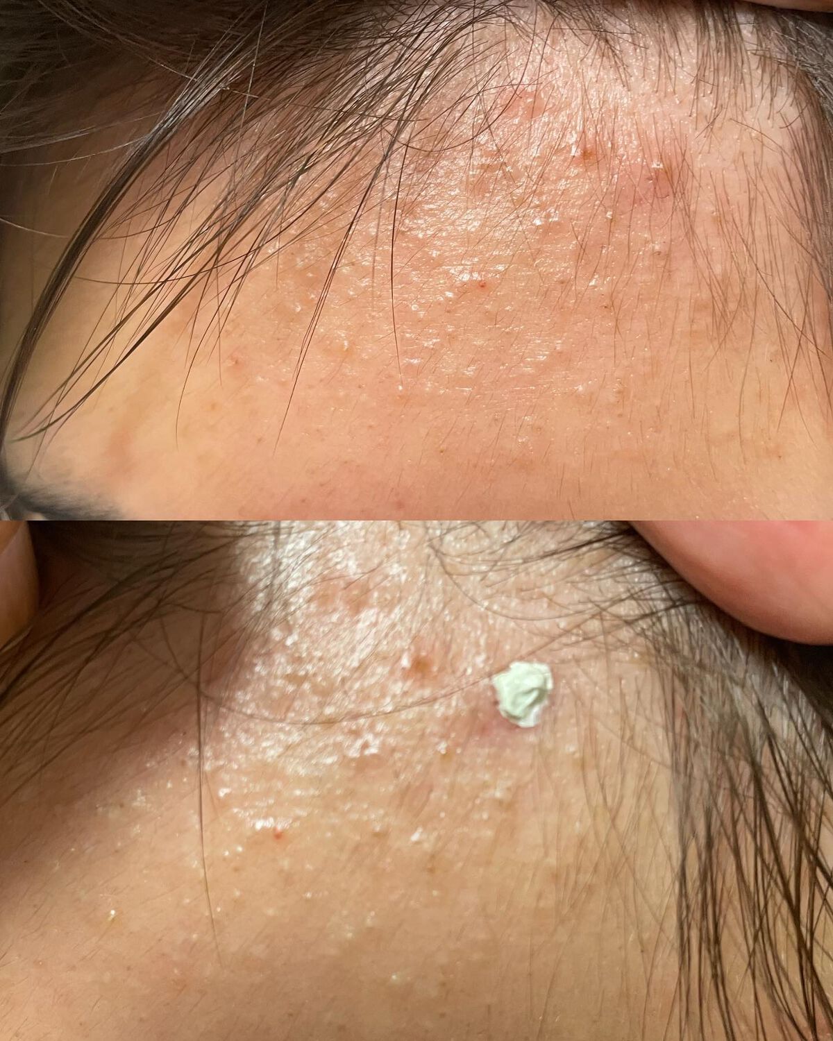 ミラクルアクネクリアスポットトリートメント/SOME BY MI/美容液を使ったクチコミ(5枚目)