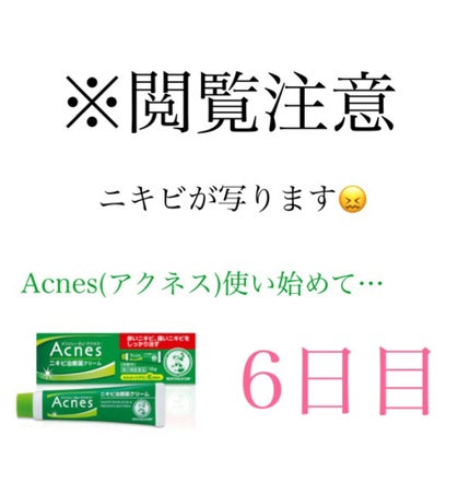 ニキビ治療薬(医薬品)/メンソレータム アクネス/その他を使ったクチコミ(1枚目)