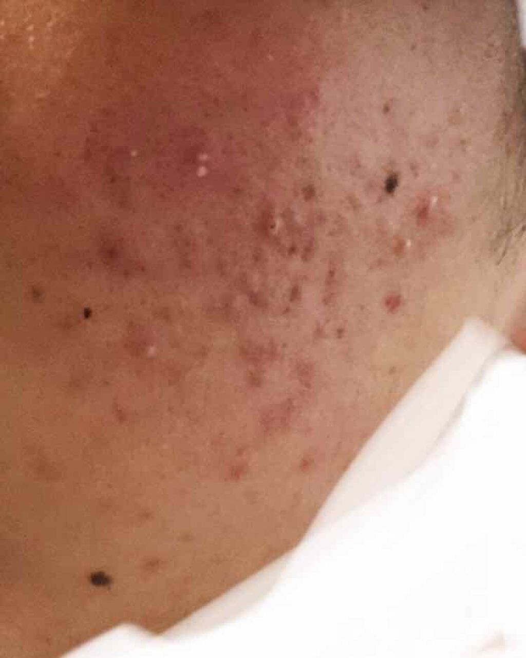 sparkle_perfume_hyx on LIPS 「思春期ニキビがなかなか治りません。生活習慣に気をつけて完食を辞..」(1枚目)