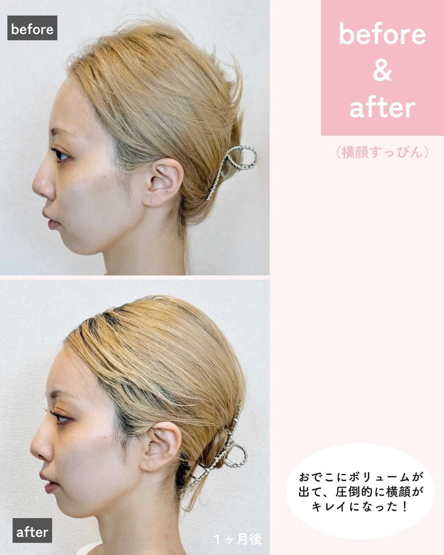 えむちゃん|3度のメシよりスキンケア on LIPS 「【おでこにヒアルロン酸入れてきた👼✨】ずっと入れたかったおでこ..」(3枚目)