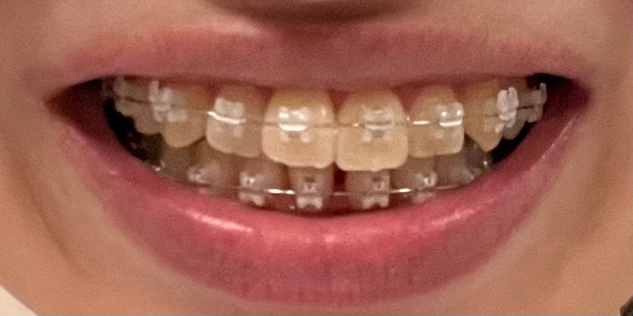 ハナ on LIPS 「向かって左側の前から2番目の歯!!すっごい動いてない!?8/1..」(3枚目)