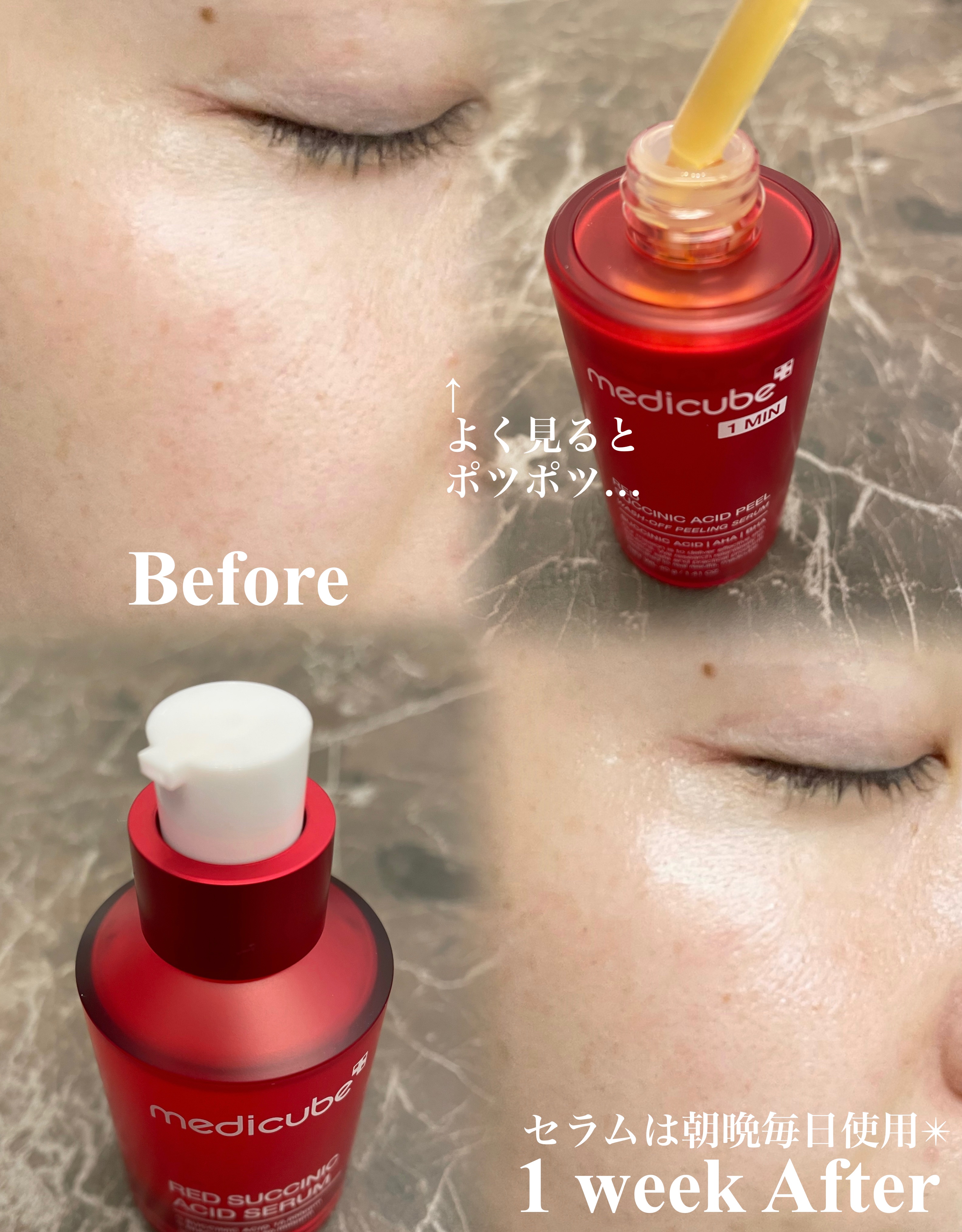 レッドアクネピーリングセラム/MEDICUBE/美容液を使ったクチコミ（2枚目）