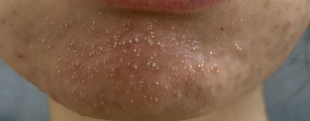 試してみた ボタニカルピーリングパウダー ベースジェルlevel1 Botanical Peel Lips