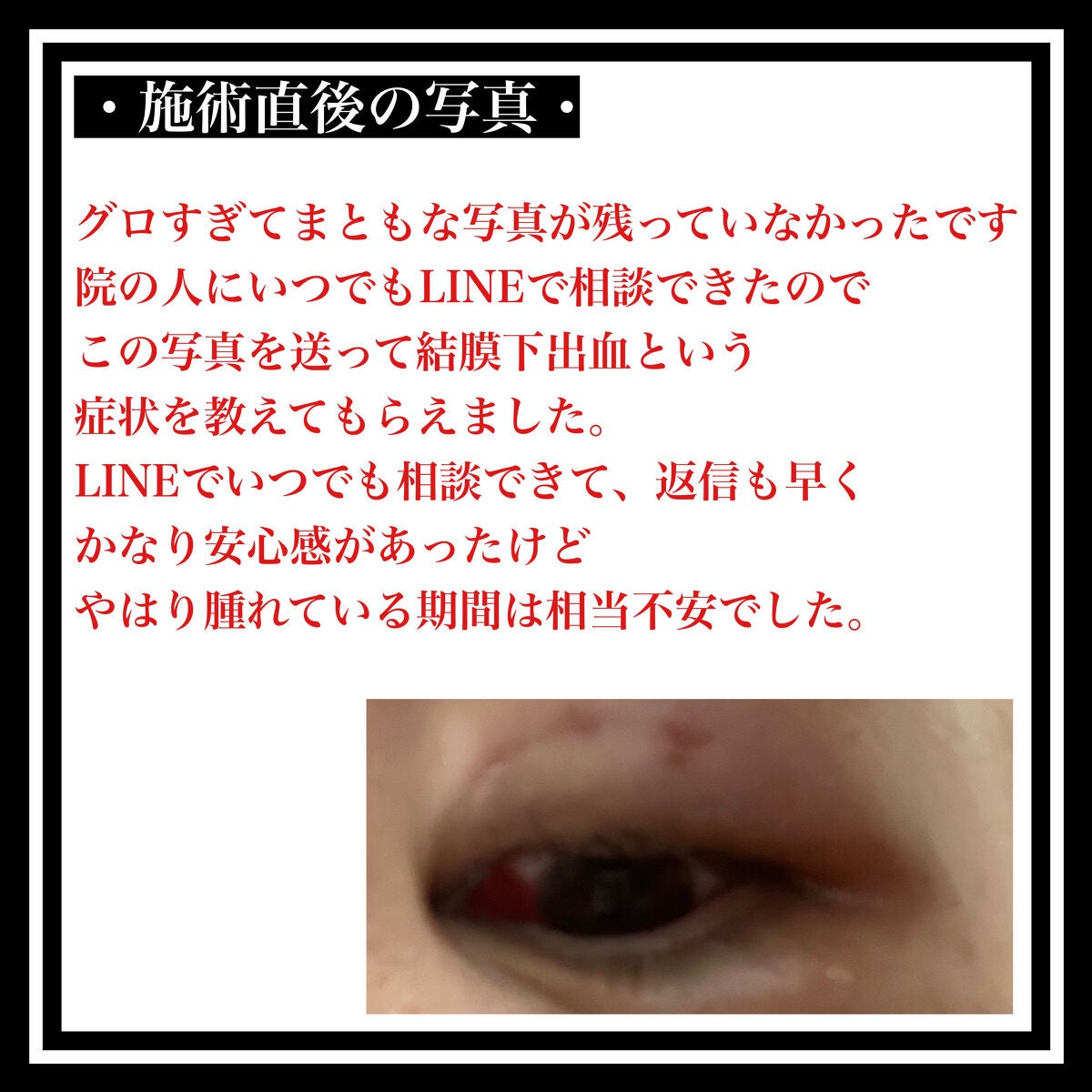 のびーるアイテープ(絆創膏タイプ、レギュラー)/DAISO/二重まぶた用アイテムを使ったクチコミ(9枚目)