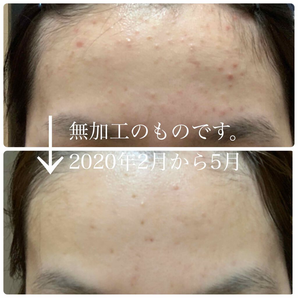 A アクネフォーム/NOV/洗顔フォームを使ったクチコミ（3枚目）