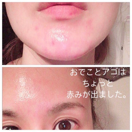 白ゆり@美容ブロガー on LIPS 「湘南美容外科でダーマペン4を受けてきました。୨୧┈┈┈┈┈..」(8枚目)