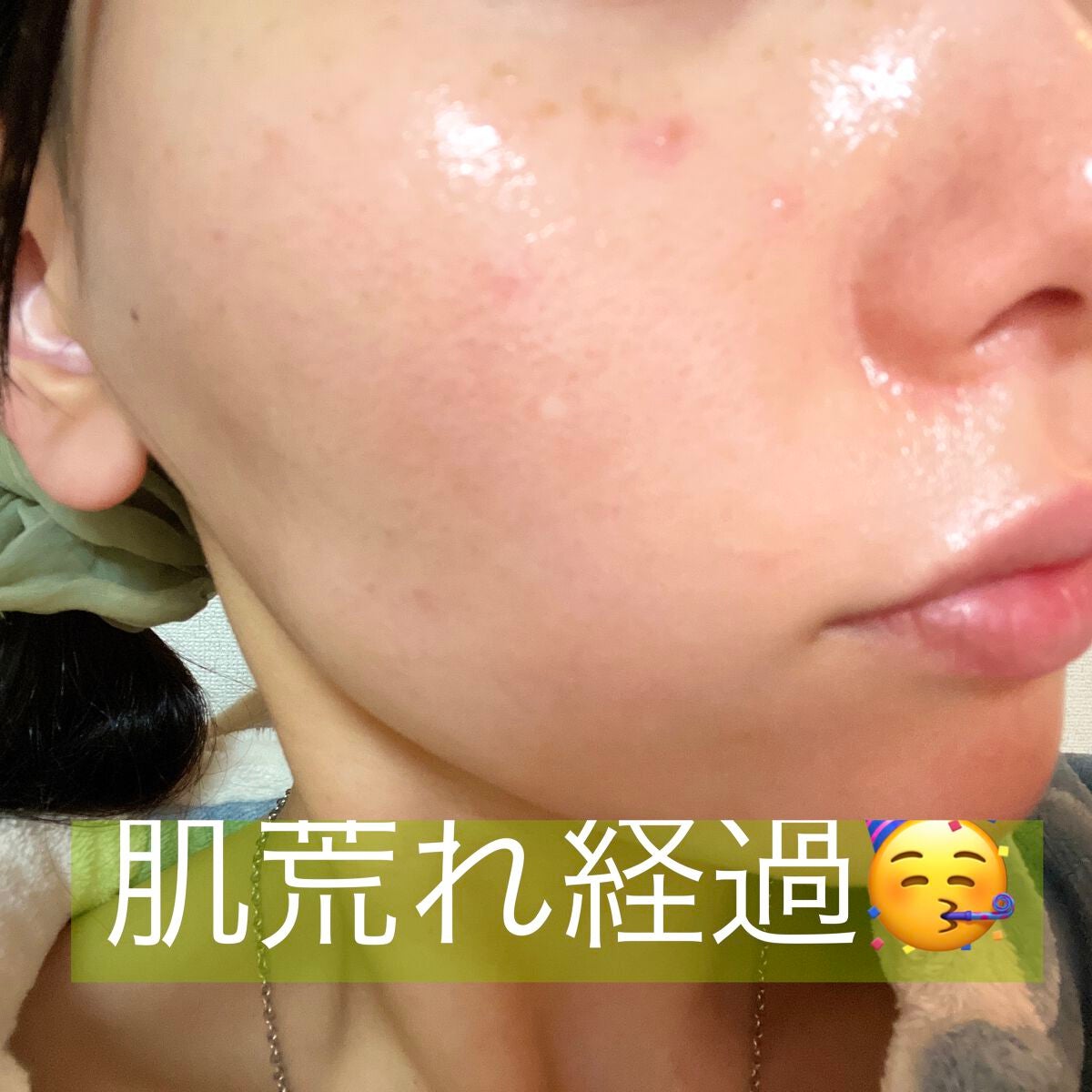 テラ・コートリル 軟膏(医薬品)/ジョンソン・エンド・ジョンソン/その他を使ったクチコミ(2枚目)