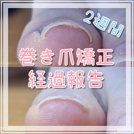 Ingrown Toenails Correction Wire/jinail/ネイル用品を使ったクチコミ(1枚目)