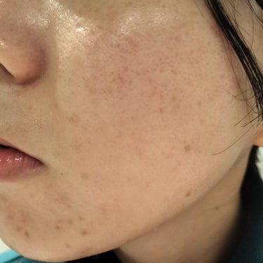 Glucolic Acid 30% Gel Peel/YEOUTH/ピーリングを使ったクチコミ（2枚目）