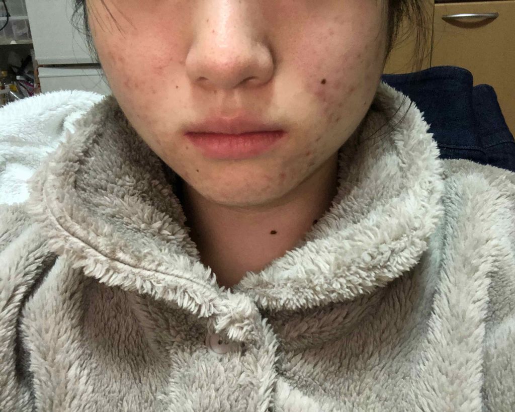 マンスリースキンケアプログラム(旧)/APEX/スキンケアキットを使ったクチコミ（2枚目）