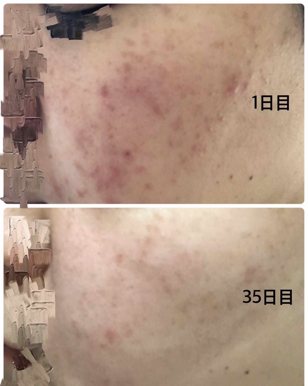 ヘパリン類似物質外用スプレー0.3%(医薬品)/持田製薬/その他を使ったクチコミ（2枚目）