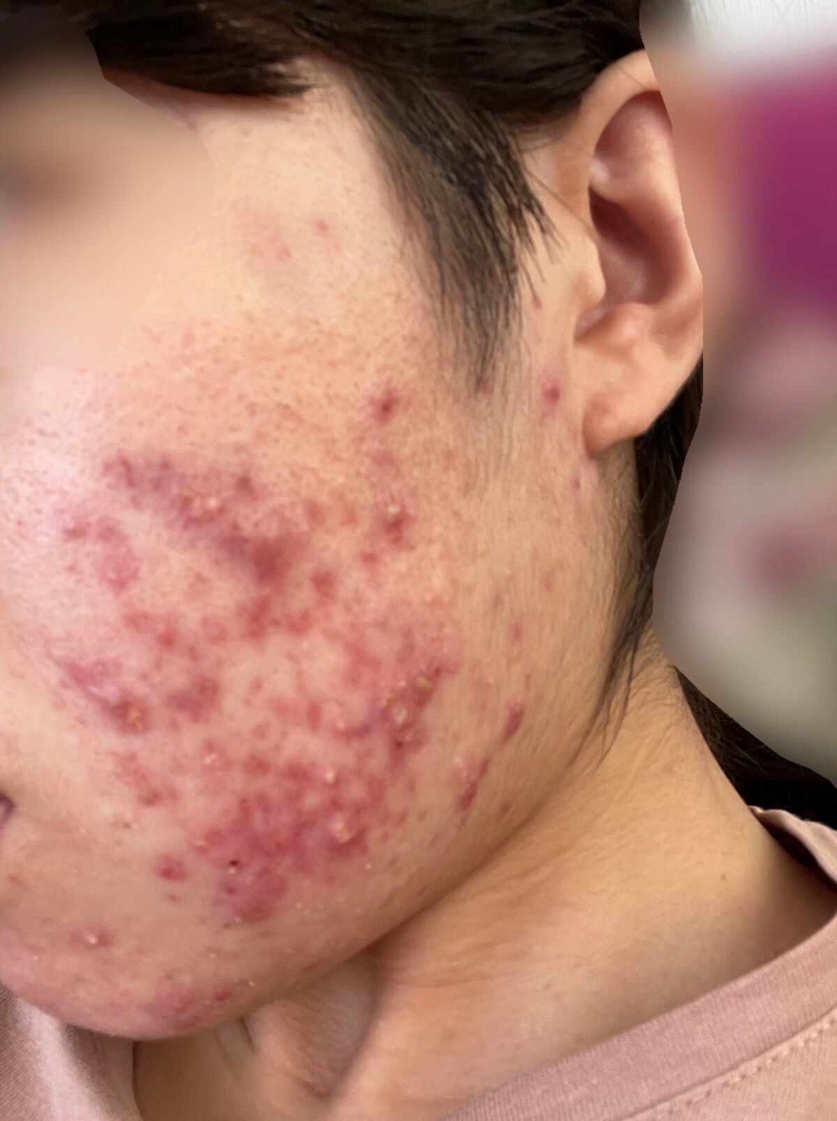 皮脂トラブルケア 保湿ジェル/キュレル/化粧水を使ったクチコミ(3枚目)