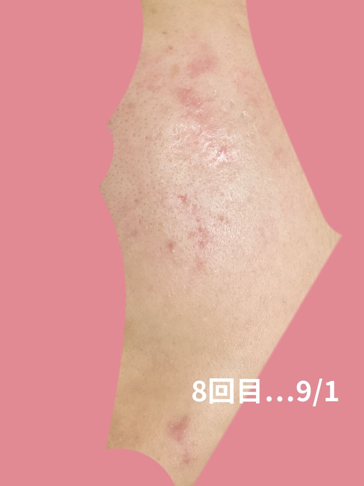 AGE-Rダーマエアショット/MEDICUBE/美顔器・マッサージを使ったクチコミ（2枚目）