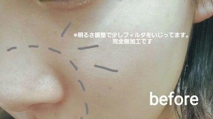 ツルリ 黒ずみ吸着 ガスールパック/ツルリ/洗い流すパック・マスクを使ったクチコミ(1枚目)