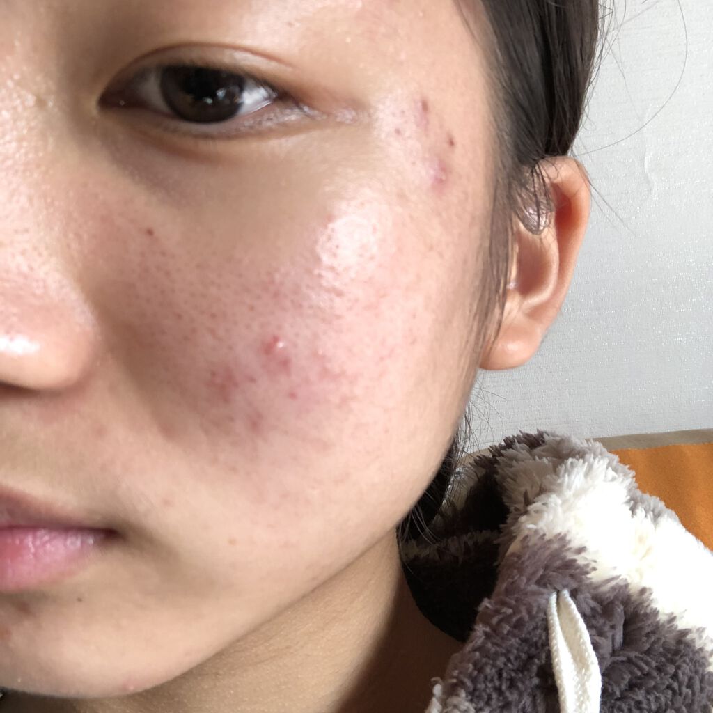 モイスチュア ローション/カルテHD/化粧水を使ったクチコミ（1枚目）