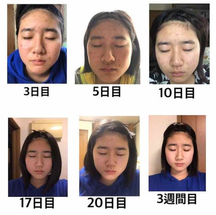 ロゼット洗顔パスタ アクネクリア/ロゼット/洗顔フォームを使ったクチコミ(4枚目)