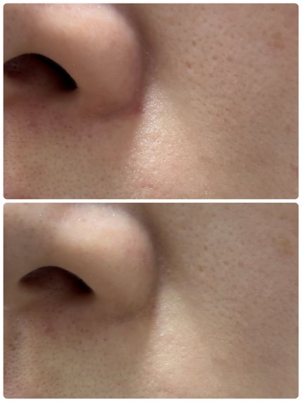 薬用コンシーラー アクネプロテクター/ONLY MINERALS/パウダーコンシーラーを使ったクチコミ(1枚目)