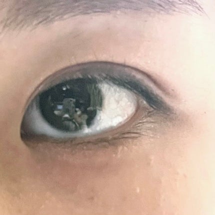 ししっぴ。フォロバはお任せください💕 on LIPS 「ししっぴ。の二重埋没法ダウンタイム、本日の記録です!こちらはメ..」(4枚目)