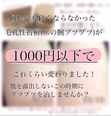 二の腕のブツブツが気になる人に是非使ってほしい！！カミソリ負けの赤いブツブツにも効きました！！

ケラチナミン/20%尿素配合クリーム

私の二の腕のブツブツは、母も姉もなっているので遺伝だと思いますが