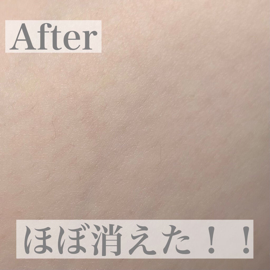 つるすべ除毛パッド/DAISO/ムダ毛ケアを使ったクチコミ(6枚目)