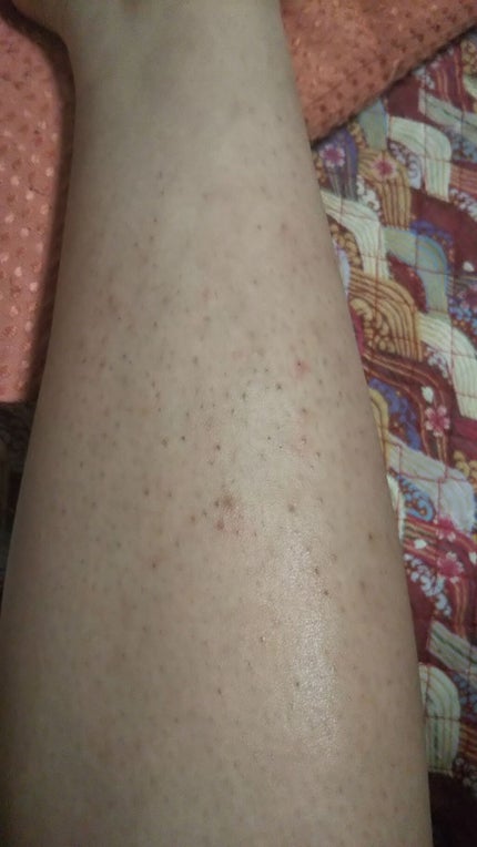 ゆん on LIPS 「私は中学一年生の時くらいに毛が気になり始めて、家にあったカミソ..」(3枚目)