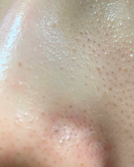 ツルリ 黒ずみ吸着 ガスールパック/ツルリ/洗い流すパック・マスクを使ったクチコミ(4枚目)